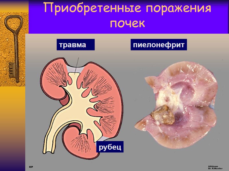 Приобретенные поражения почек рубец травма пиелонефрит